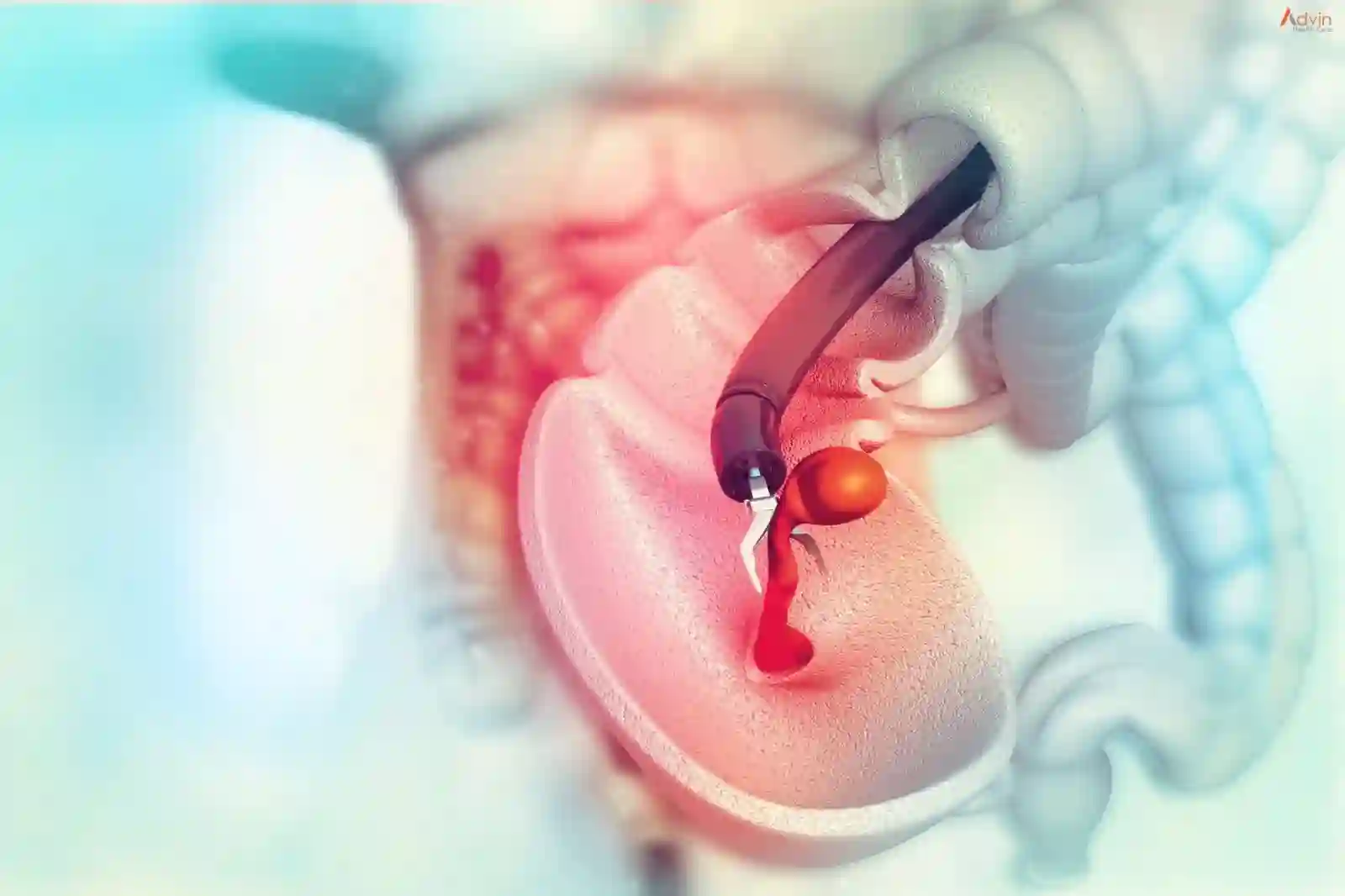 Colonoscopy